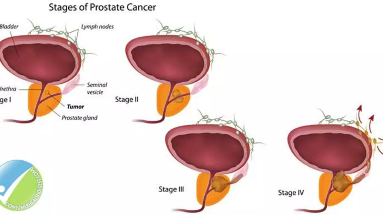 Flutamide and Fertility: What Prostate Cancer Patients Should Know